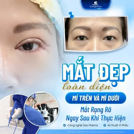 Ưu điểm cắt mí 4 trong 1 Plasma