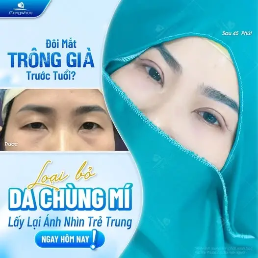 Cắt mí Perfect là giải pháp thẩm mỹ mắt tối ưu mang đến đôi mắt 2 mí rõ nét