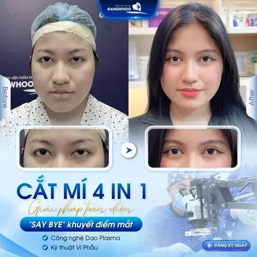Cắt Mí - Lấy Mỡ Bọng Mắt - Combo Trẻ Hóa Toàn Diện