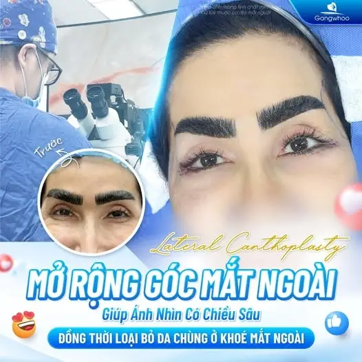 Mở Rộng Góc Mắt Giúp Mắt To Tròn Long Lanh