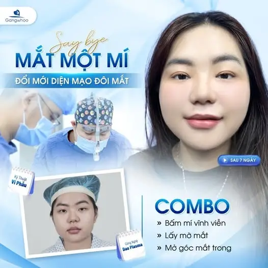 Mắt to tròn, long lanh sau khi mở rộng góc mắt