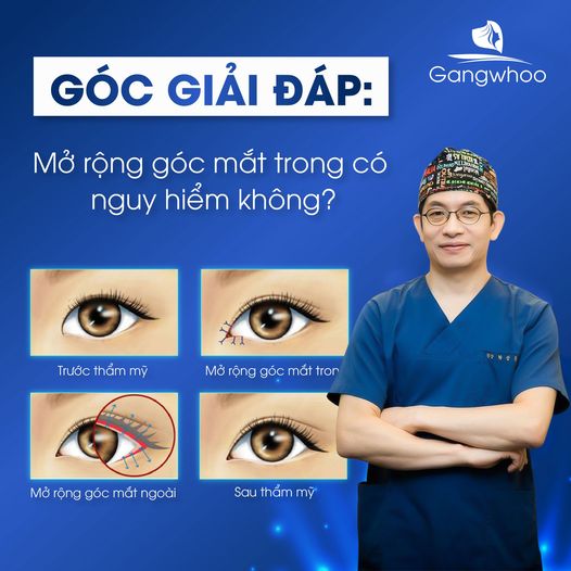 Mở góc mắt trong là tiểu phẫu đơn giản và có độ an toàn cao, nếu bạn thực hiện tại cơ sở thẩm mỹ uy tín