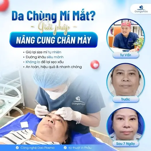 Nâng cung chân mày - Sự lựa chọn hoàn hảo giúp bạn lấy lại nét tươi sáng
