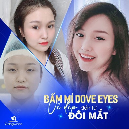 Bấm Mí (Dove Eyes), Thổi Hồn Cho Đôi Mắt Long Lanh