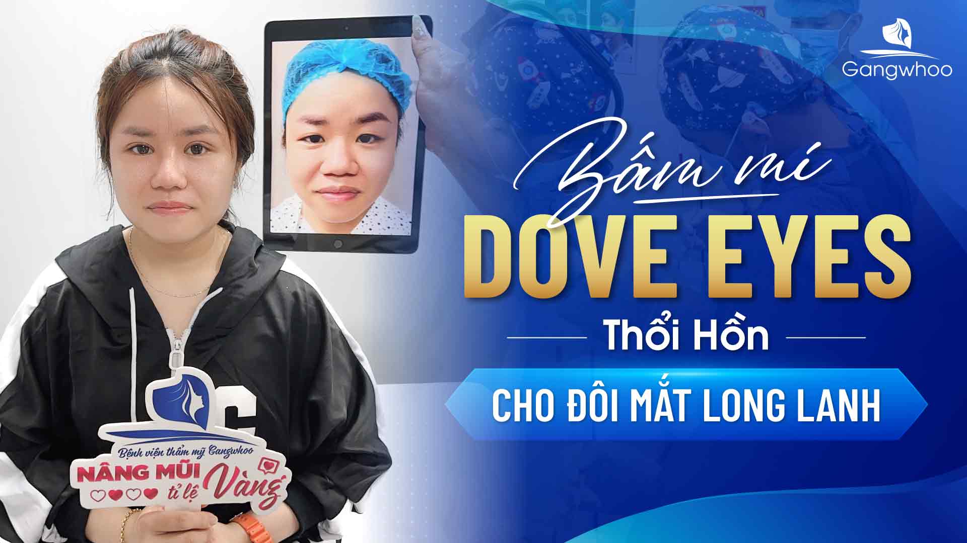 Bấm Mí Dove Eyes, Thổi Hồn Cho Đôi Mắt Long Lanh (Hot Trend 2024)