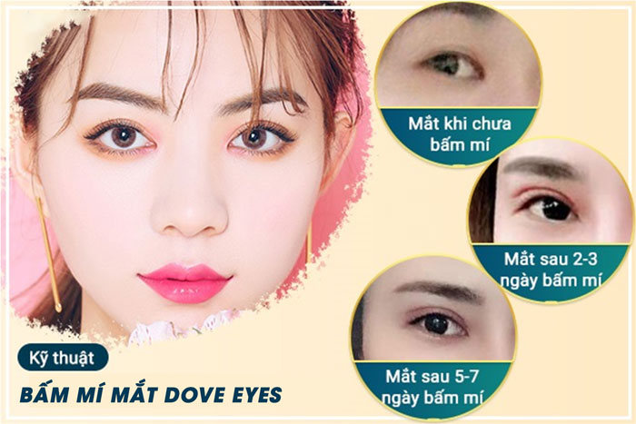 Bấm Mí Dove Eyes | Dịch Vụ Làm Đẹp Số 1 Việt Nam