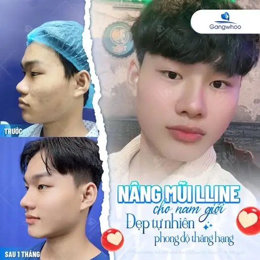 Đến Gangwhoo để sở hữu dáng mũi đẹp tự nhiên, lâu bền