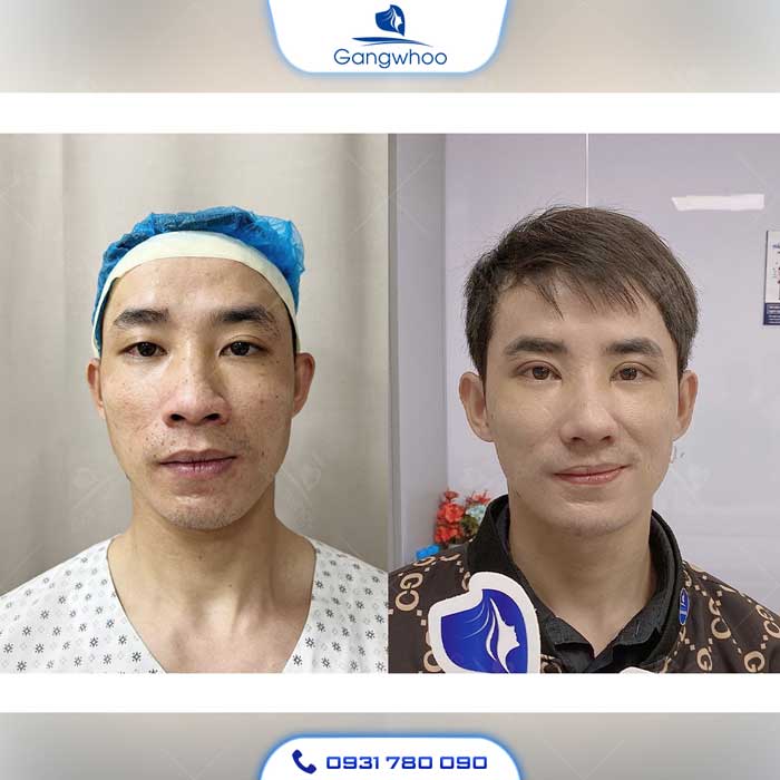 Độn Cằm (Korea Implant) 5