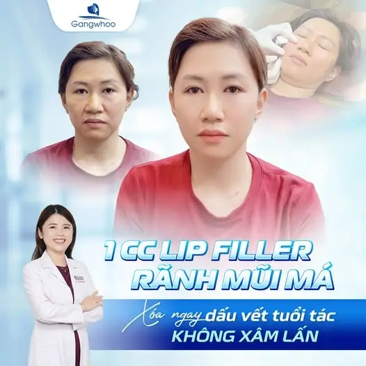Xóa nhăn rãnh cười - Lấy lại tuổi thanh xuân