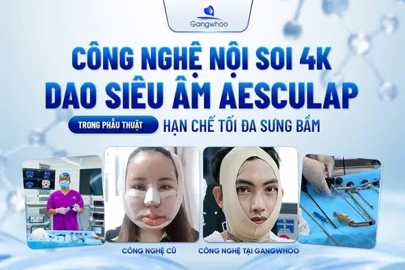 Bác sĩ Phùng Mạnh Cường thực hiện với công nghệ nội soi 4K giúp hạn chế tối đa sưng bầm