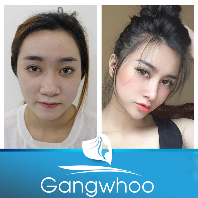 Khách hàng trải nghiệm dịch vụ nâng mũi tại TMV Gangwhoo