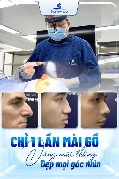 Mài gồ xương mũi - Mũi đẹp chuẩn "thần thái"