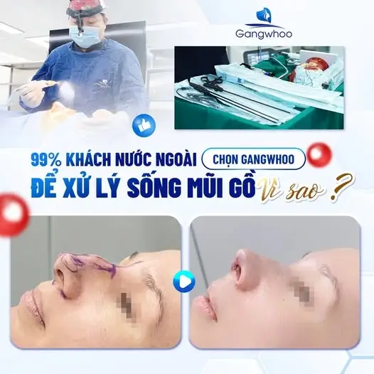 Mài gồ xương mũi giúp khắc phục được khuyết điểm mũi bị gồ hiệu quả