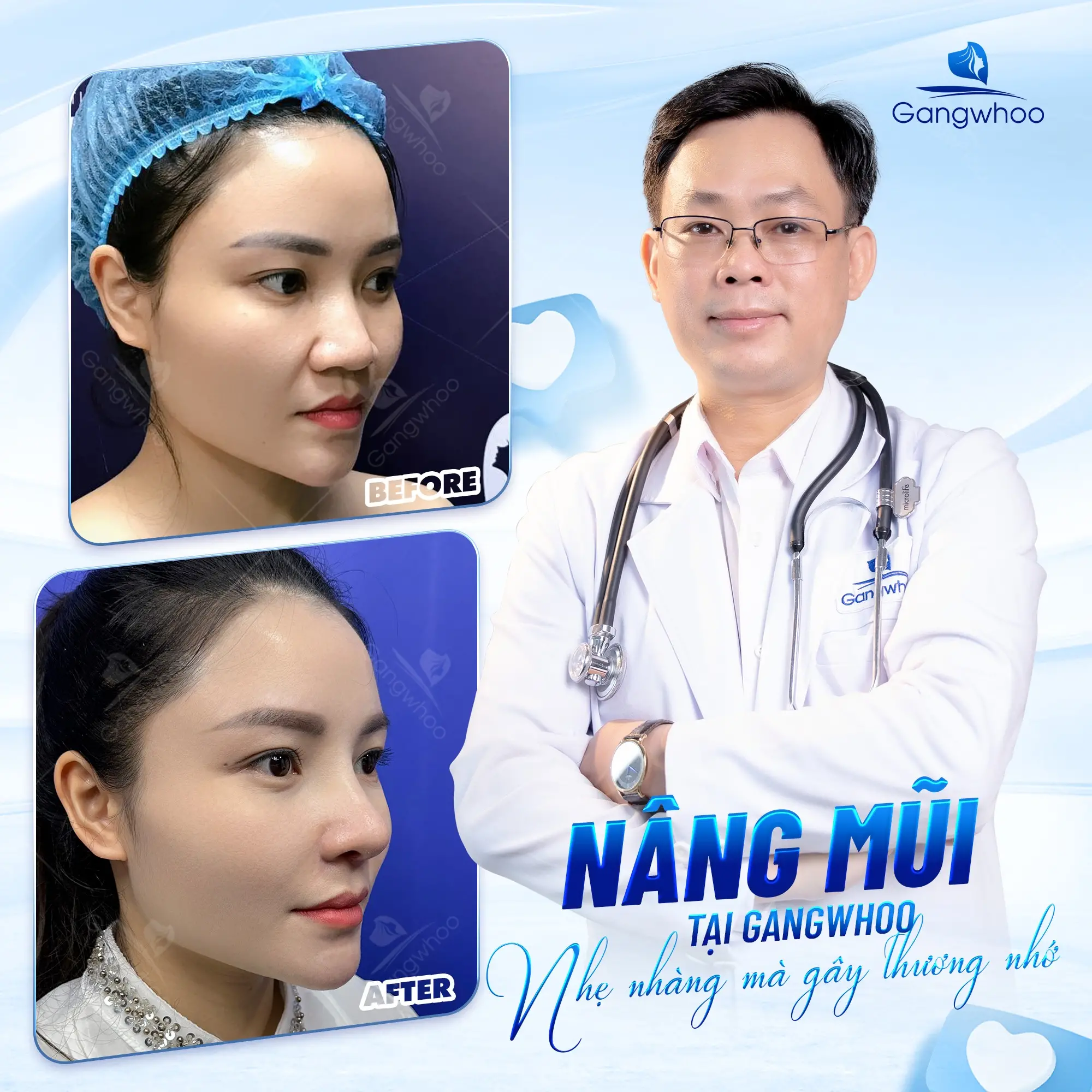Nâng Mũi Bọc Sụn Tự Thân – Giải Pháp Cho Dáng Đẹp Hài Hòa