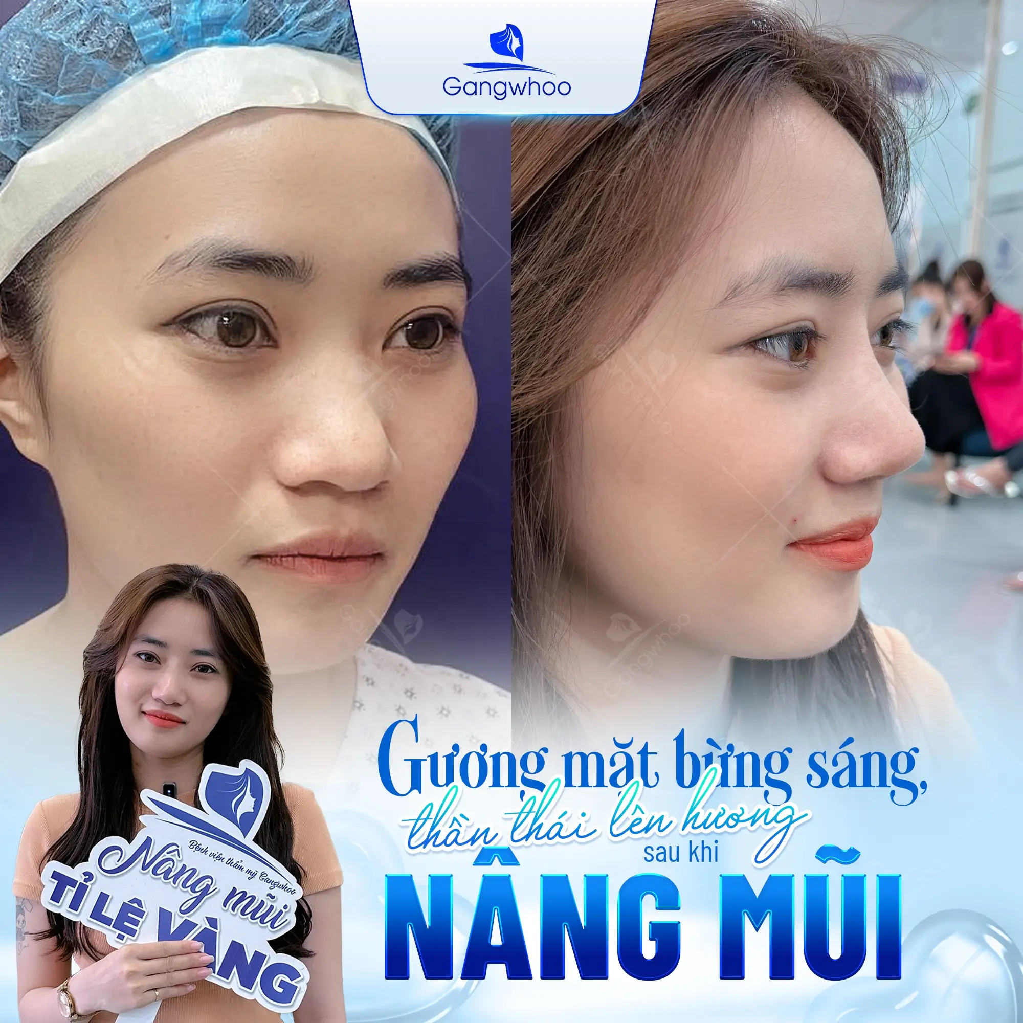 Nâng Mũi Bọc Sụn Tự Thân – Giải Pháp Cho Dáng Đẹp Hài Hòa