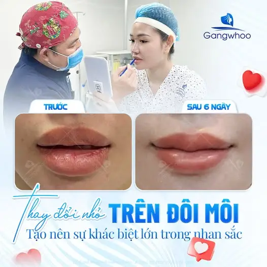 Tạo hình môi trái tim không phẫu thuật giúp khắc phục nhược điểm môi mỏng xấu