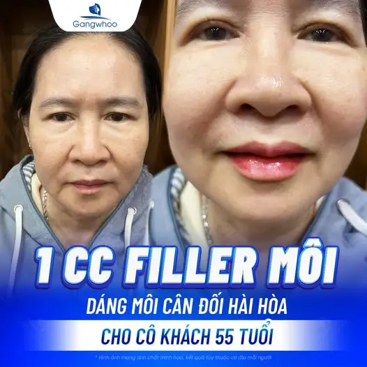 Sở hữu đôi môi trái tim là ước mơ cùa nhiều chị em