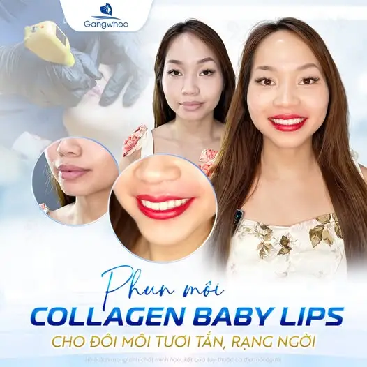 Tạo hình môi trái tim không phẫu thuật là phương pháp sử dụng chất làm đầy (Filler) tạo hình đôi môi