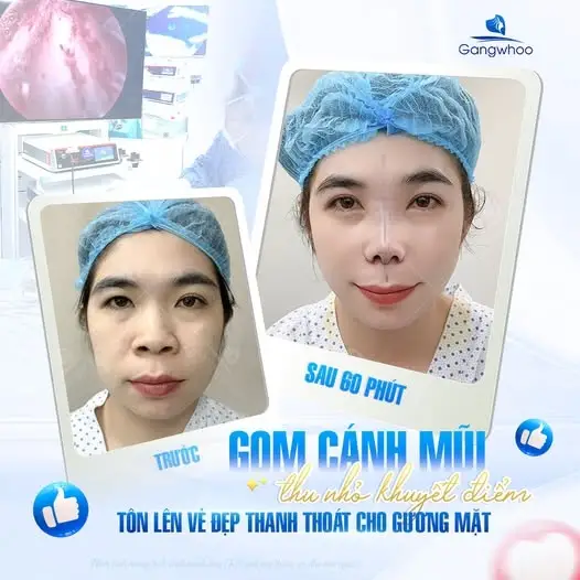 Thun gon cánh mũi - Giải pháp có tình trạng cánh mũi to, bè
