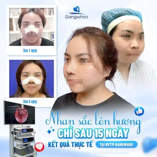 Gương mặt thanh tú sau khi thực hiện thu gọn cánh mũi