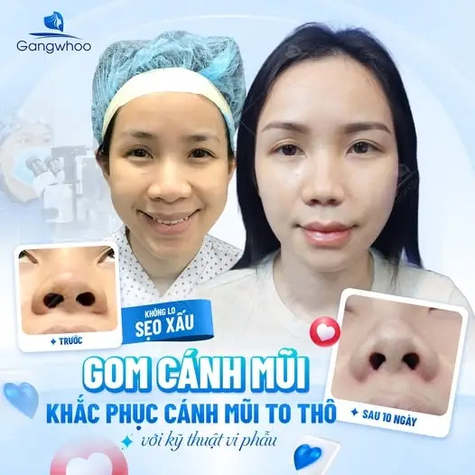 Thu gọn cánh mũi bao lâu thì lành và hết sưng?