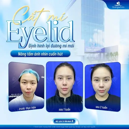Ưu điểm khi cắt mí Eyelid tại Gangwhoo