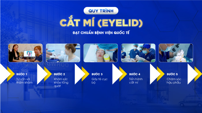 quy trình cắt mí mắt tại TMV Gangwhoo