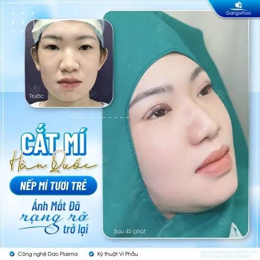 Giới thiệu kỹ thuật cắt mí mắt Hàn Quốc tại Gangwhoo