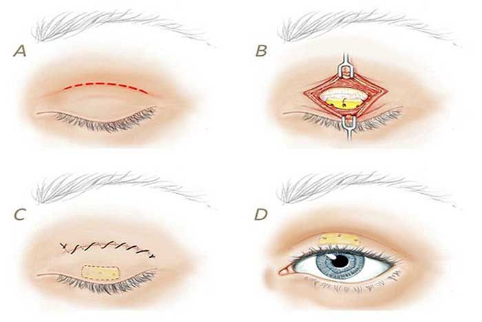 Mô phỏng kỹ thuật cắt mí mắt
