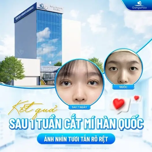 Ưu điểm khi cắt mí Hàn Quốc đẹp chuẩn