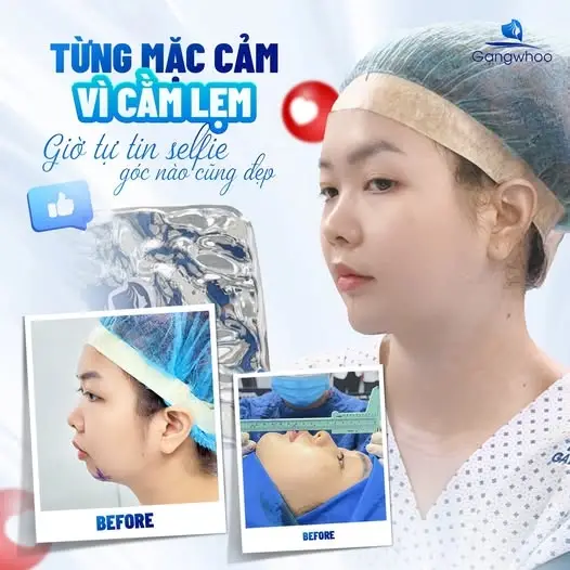 Mặt đẹp chuẩn V-Line với công nghệ độ cằm Korea Implant