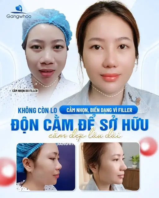 Độn cằm Korea Implant không phân biệt giới tính