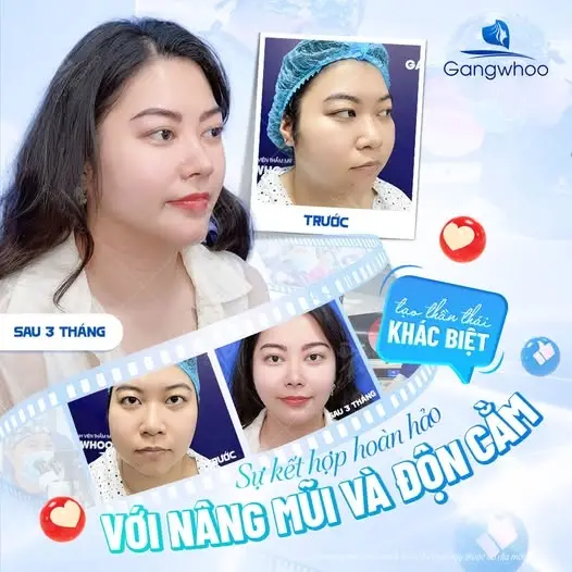 Nâng tầm nhan sắc với combo cắt mí & độn cằm