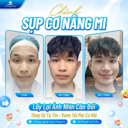 Ca chỉnh sụp cơ nâng mi thành công tại TMV Gangwhoo