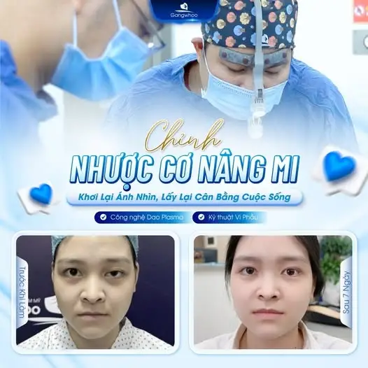 Cải thiện tầm nhìn đáng kể sau khi chỉnh sụp cơ nâng mi