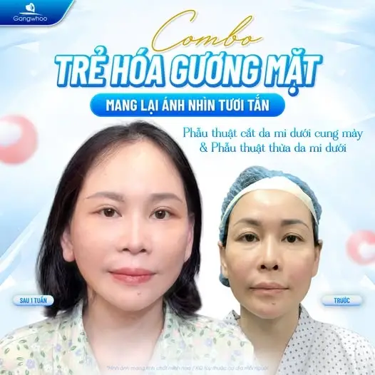 Những ai nên thực hiện căng da mặt