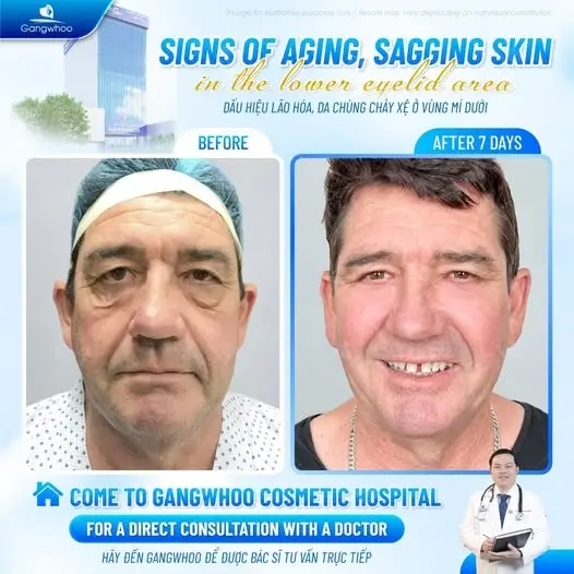 Quy trình thực hiện căng da mặt tại TMV Gangwhoo