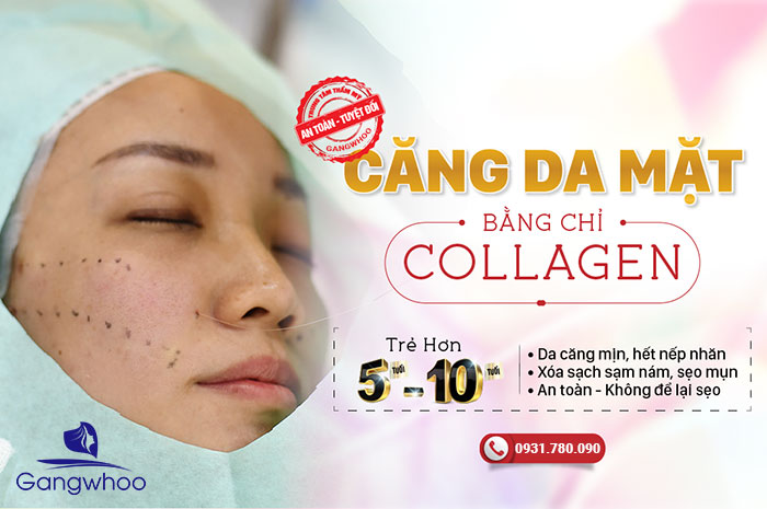 Phương pháp căng da mặt bằng chỉ Collagen (căng da mặt có nguy hiểm không)