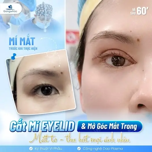 Mở Góc Mắt Trong Mini Giúp Mắt To Và Xinh Lung Linh