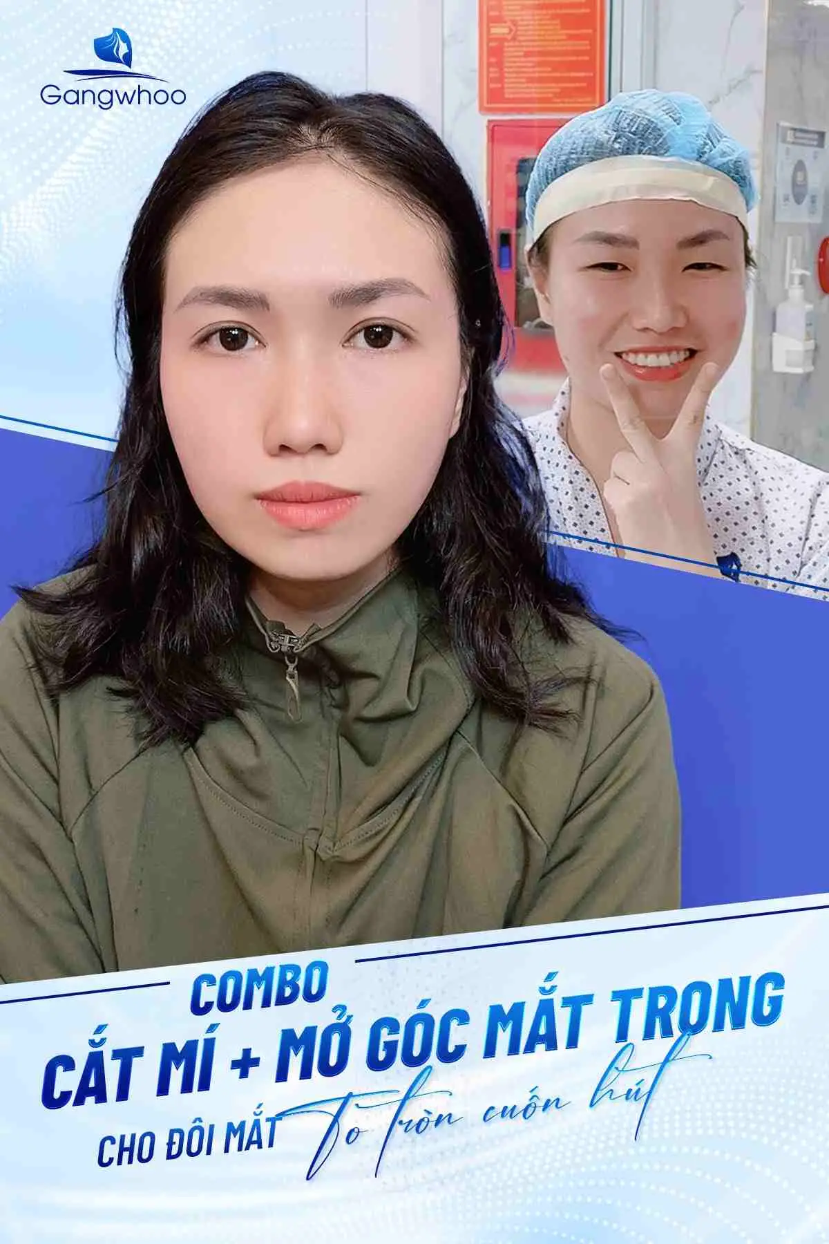 Góc mắt được mở rộng giúp đôi mắt to tròn tự nhiên