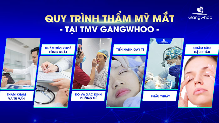 Quy trình thẩm mỹ mắt tại TMV Gangwhoo