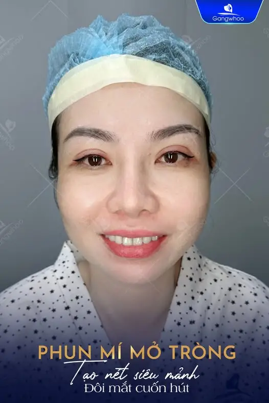 Phun mí mắt trên cải thiện các khuyết điểm như mắt hí, mí mắt nhỏ, mắt lồi.