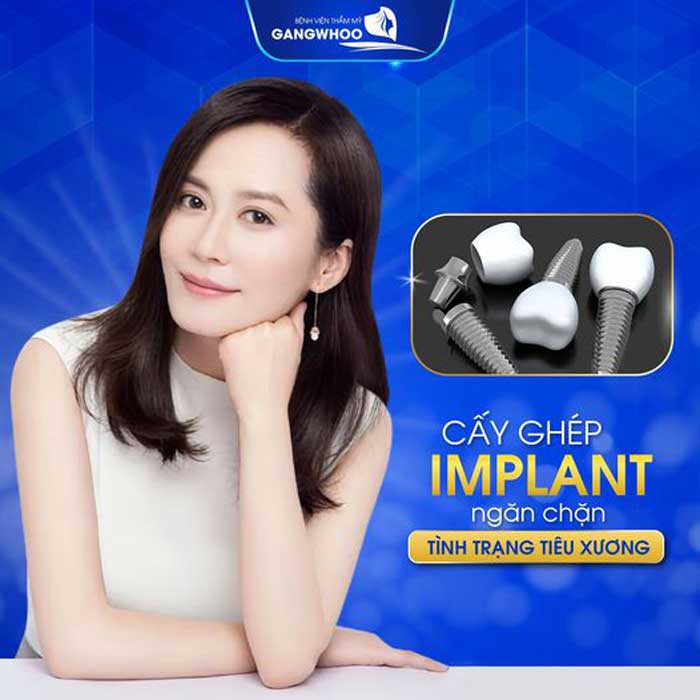 Cấy Ghép (Implant) Giúp Răng Đều, Đẹp Tự Nhiên Khi Cười