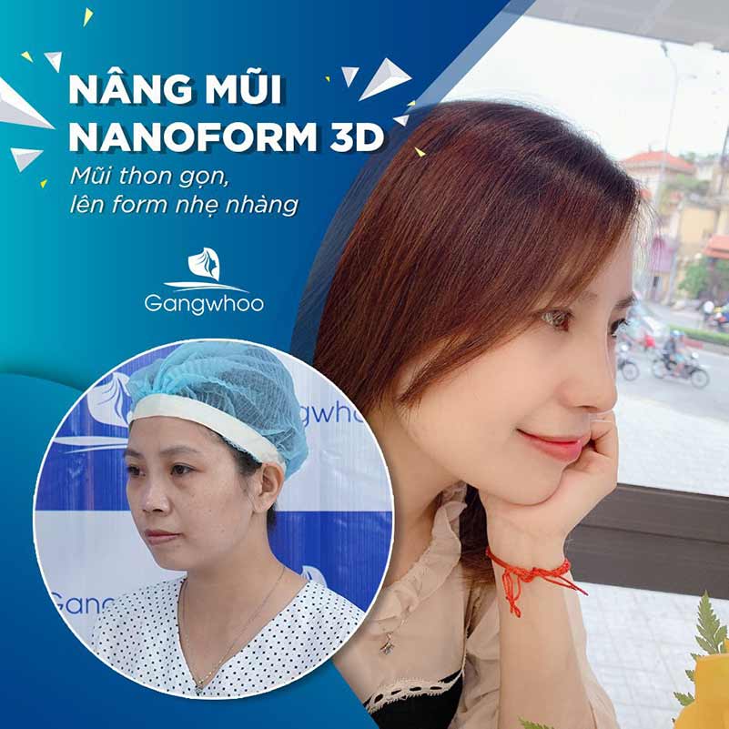 Khách hàng nâng mũi Nanoform 3D