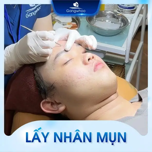 Thực hiện lấy nhân mụn