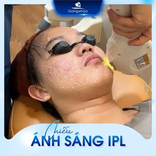 Bắn tia IPL diệt khuẩn mụn