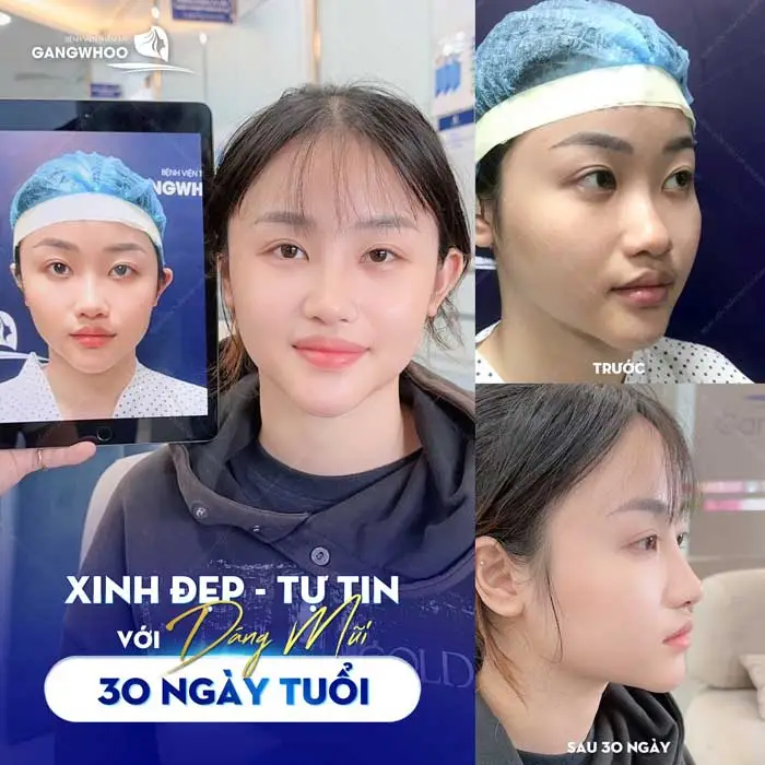 Nâng Mũi Nanoform Là Gì? Có Tốt Không?