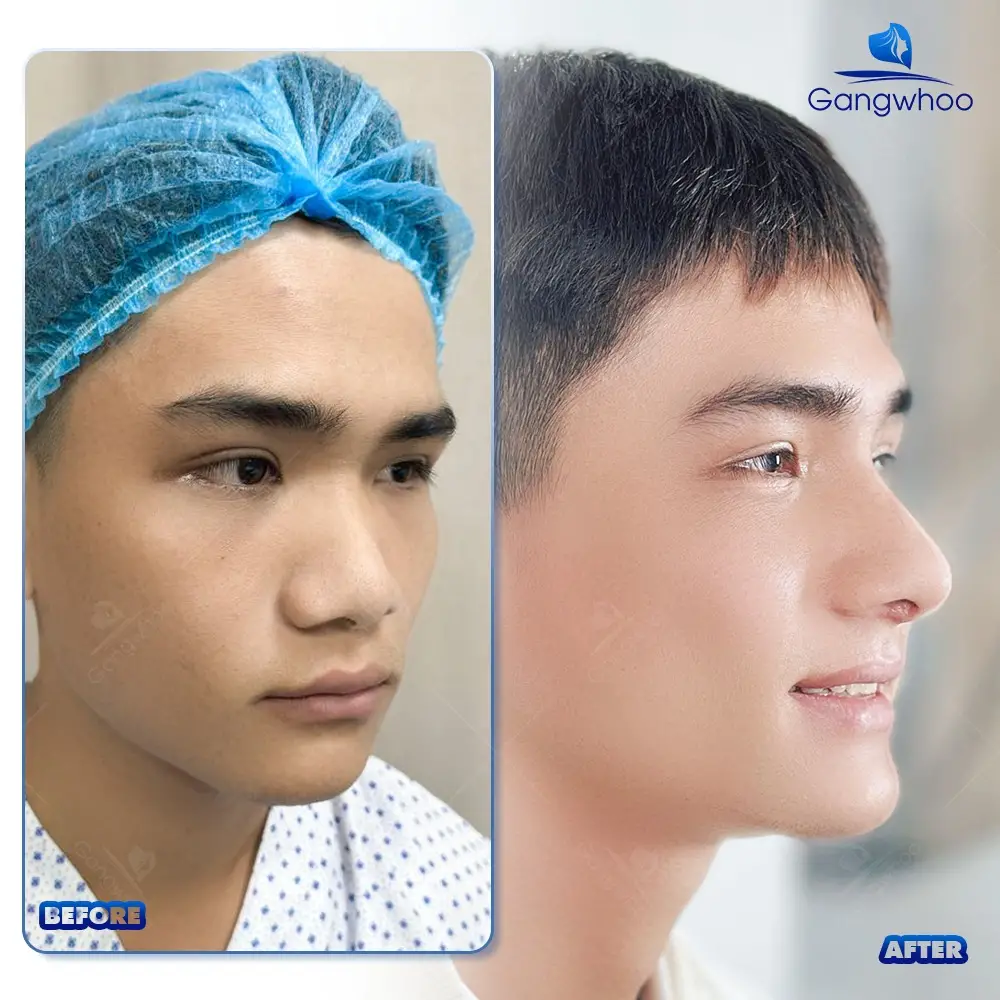 Nâng Mũi Nanoform Là Gì? Có Tốt Không?