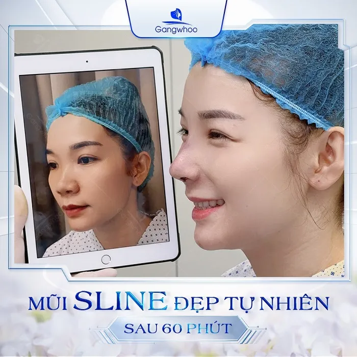 Ưu điểm nâng mũi S line 6D