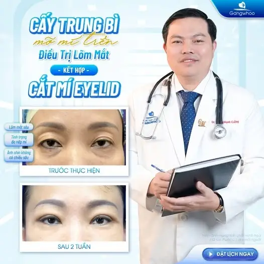 Tái Tạo Mỡ Mắt: Đôi Mắt Tự Nhiên - Đẹp Rạng Ngời